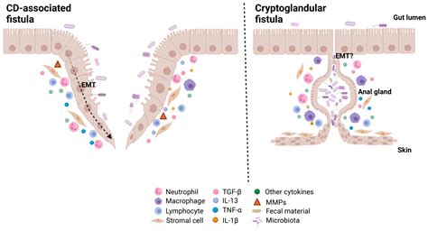 cryptoglandular fistula